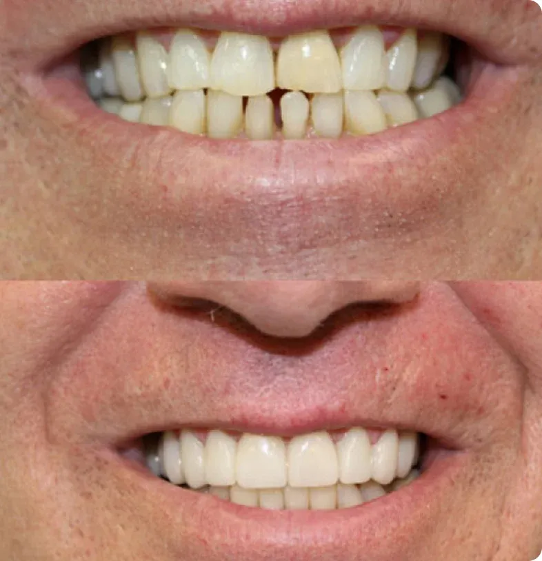 Dental Crown Types