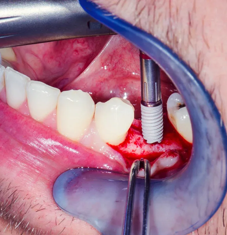 Dental Crown Types